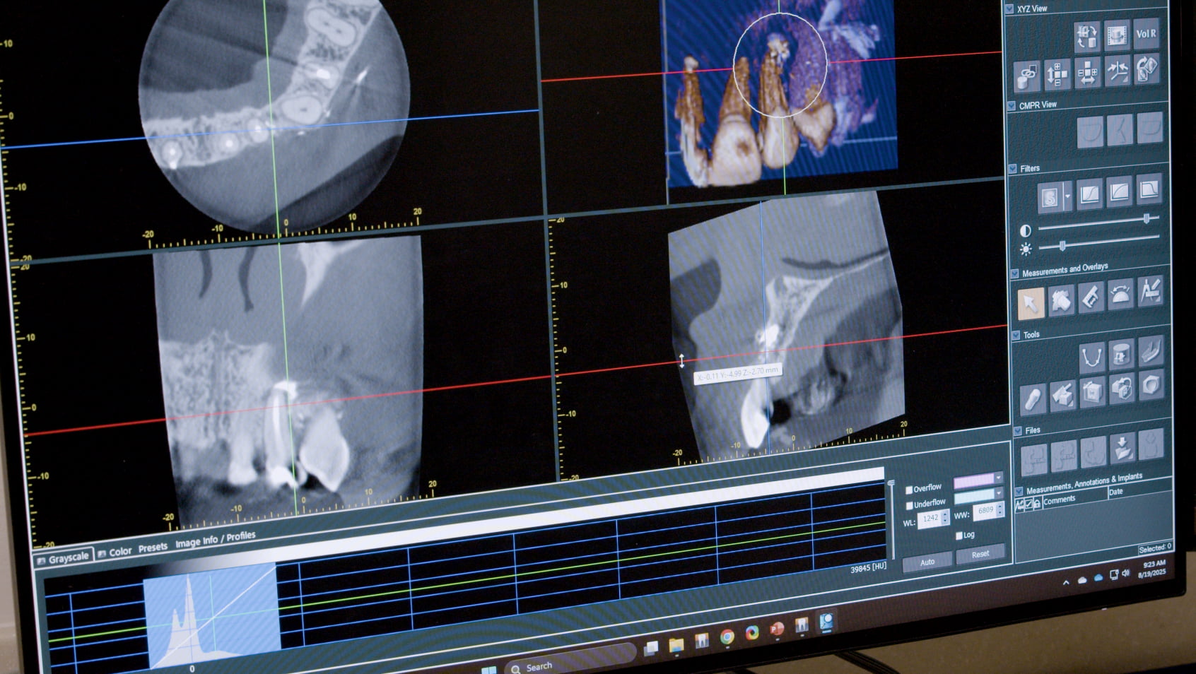 A dental imaging software display showing multiple views of a cone beam CT scan on a monitor.